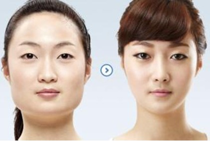 下頜角切除的價錢