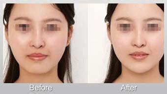 下頜角切除的價錢