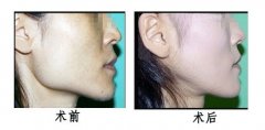 下頜角整形會不會留下疤痕