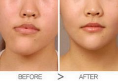 一起來了解口角歪斜修復