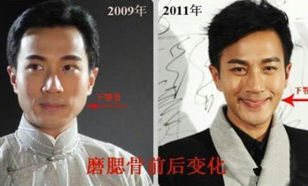 盤點娛樂圈三大男士下頜角整形的成功范例