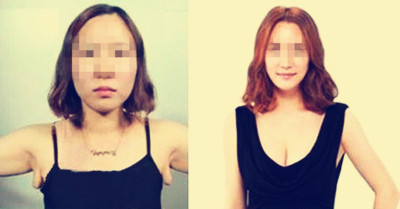 做副乳手術需要多少錢價格 副乳切除手術后果對比照片圖