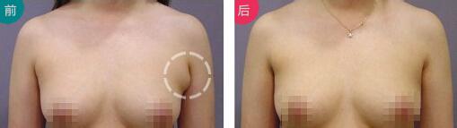 做副乳手術需要多少錢價格 副乳切除手術后果對比照片圖