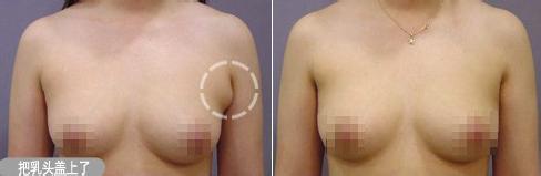 做副乳手術需要多少錢價格 副乳切除手術后果對比照片圖
