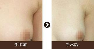做副乳手術需要多少錢價格 副乳切除手術后果對比照片圖