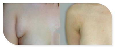 做副乳手術需要多少錢價格 副乳切除手術后果對比照片圖