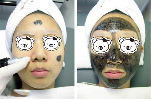 如何使面部毛孔收縮 收縮毛孔手術(shù)去黑頭