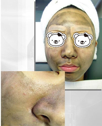 如何使面部毛孔收縮 收縮毛孔手術(shù)去黑頭