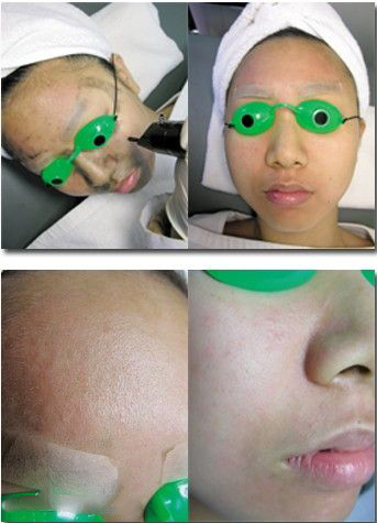 如何使面部毛孔收縮 收縮毛孔手術(shù)去黑頭