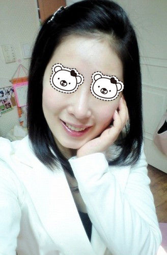 如何使面部毛孔收縮 收縮毛孔手術(shù)去黑頭