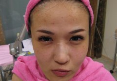 如何使面部毛孔收縮 收縮毛孔手術(shù)去黑頭