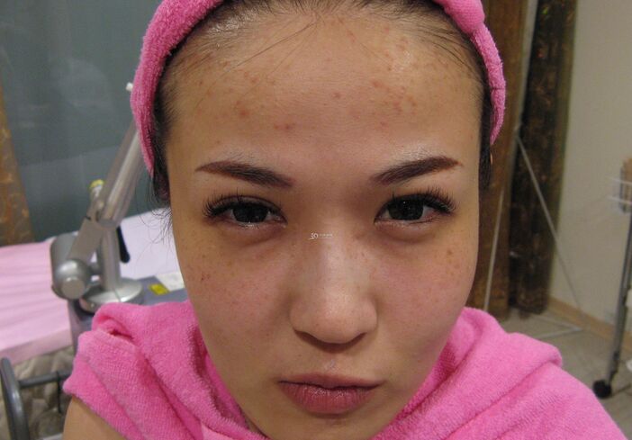 如何使面部毛孔收縮 收縮毛孔手術(shù)去黑頭