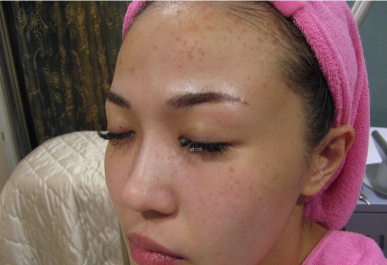 如何使面部毛孔收縮 收縮毛孔手術(shù)去黑頭