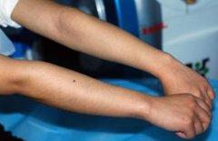 冰點華爾茲激光疼痛感較輕脫毛價格表多少錢 冰點華爾茲激光疼痛感較輕脫毛有什么副作用