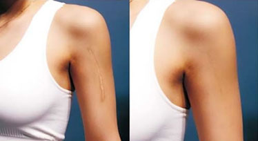 像素激光祛疤詳細(xì)介紹 像素激光祛疤果對(duì)比圖