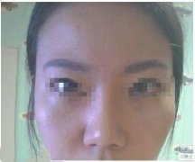 下頜角截骨術(shù)怎么樣 下頜角截骨術(shù)案例分享 下頜角截骨術(shù)怎么樣 下頜角截骨術(shù)案例分享