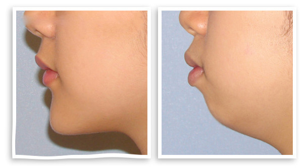 隆下頜的果怎么樣 隆下頜手術(shù)前后對(duì)比圖