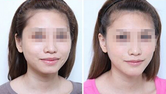隆下頜的果怎么樣 隆下頜手術(shù)前后對(duì)比圖