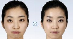 隆下頜的成好嗎 隆下頜手術(shù)前后對(duì)比照片 隆下頜的成好嗎 隆下頜手術(shù)前后對(duì)比照片