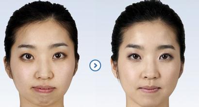 隆下頜的果怎么樣 隆下頜手術(shù)前后對(duì)比圖