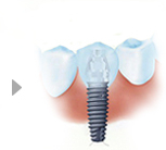 微創(chuàng)種植牙的手術(shù)過(guò)程介紹