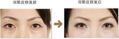 雙眼皮修復(fù)手術(shù)的適應(yīng)癥有哪些