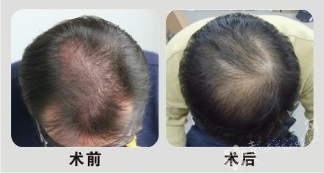 植發(fā)大約多少錢 植發(fā)手術(shù)果圖
