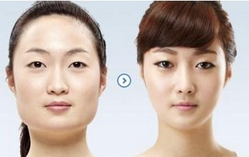 下頜角修復(fù)手術(shù)有哪些方式 下頜角修復(fù)手術(shù)前后對(duì)比圖