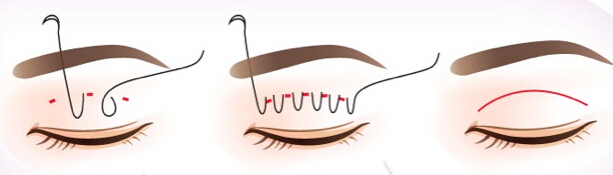 埋線定位雙眼皮做的不理想可以修復(fù)嗎