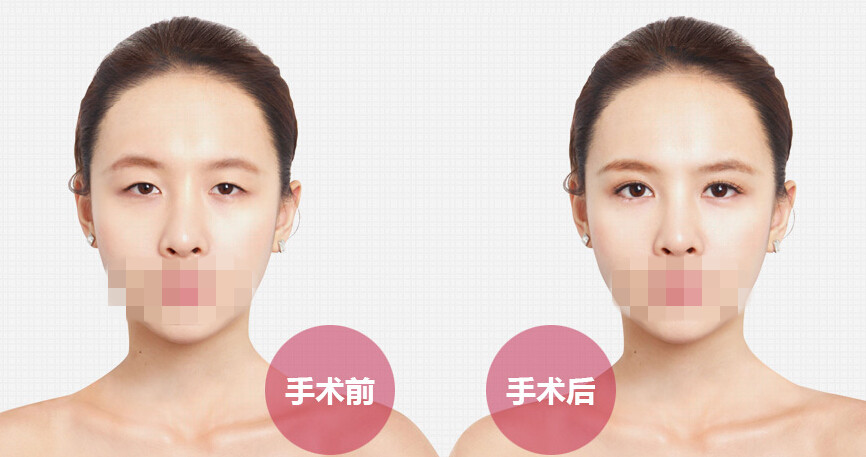 埋線定位雙眼皮做的不理想可以修復(fù)嗎