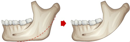 v-line和下頜角整形手術(shù)有什么區(qū)別