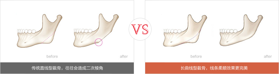 v-line和下頜角整形手術(shù)有什么區(qū)別