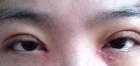 【開眼角疤痕增生】開眼角疤痕增生怎么辦 開眼角疤痕增生圖片