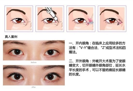 【開眼角疤痕增生】開眼角疤痕增生怎么辦 開眼角疤痕增生圖片