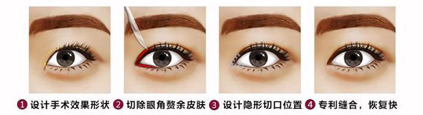 【開眼角疤痕增生】開眼角疤痕增生怎么辦 開眼角疤痕增生圖片