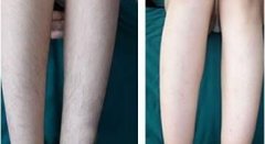 冰點脫毛好嗎 冰點脫毛有副作用嗎