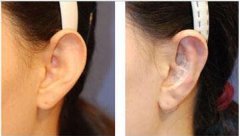 招風(fēng)耳矯正多少錢 招風(fēng)耳矯正什么時候喜歡