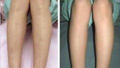 冰點脫毛果如何 冰點脫毛能保持多久