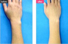 冰點脫毛需要幾次 冰點脫毛危險嗎