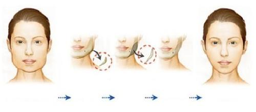 【咬肌切除】咬肌切除降低風(fēng)險嗎 咬肌切除手術(shù)副作用