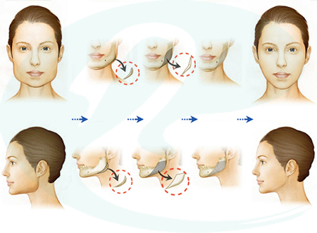 首爾麗格做下頜角磨削手術危險嗎