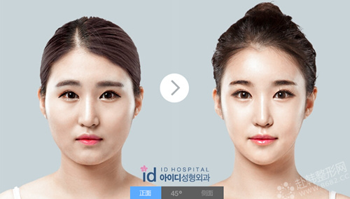 韓國vline的臉型手術價格