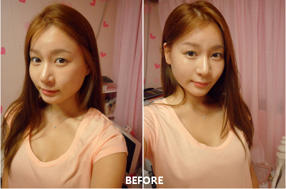 韓國vline的臉型手術價格