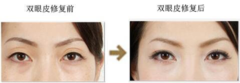如何縮短雙眼皮手術(shù)的恢復(fù)時(shí)間 割雙眼皮后怎么護(hù)理