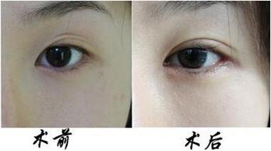 如何縮短雙眼皮手術(shù)的恢復(fù)時(shí)間 割雙眼皮后怎么護(hù)理