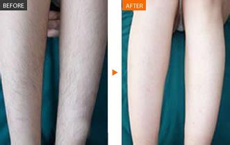 腿部脫毛價格 腿部脫毛什么季節(jié)去好