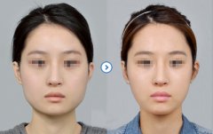 尖下頜角整形后對(duì)日常生活有影響嗎 尖下頜角整形后要注意什么 尖下頜角整形后對(duì)日常生活有影響嗎 尖下頜角整形后要注意什么