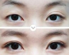 雙眼皮多久可以修復(fù)、哪些人適合做雙眼皮修復(fù)