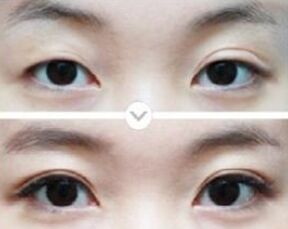 雙眼皮多久可以修復(fù),哪些人適合做雙眼皮修復(fù)
