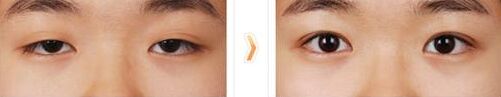 雙眼皮多久可以修復(fù),哪些人適合做雙眼皮修復(fù)